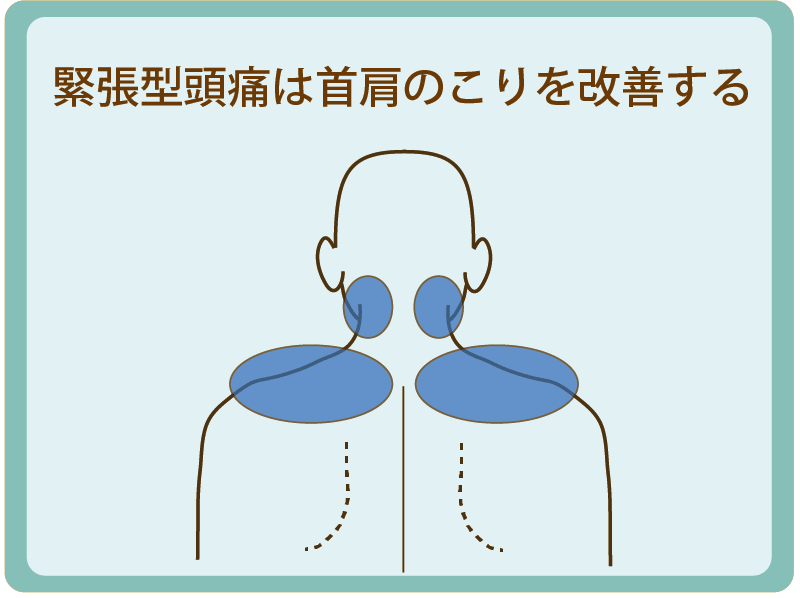緊張型頭痛の場合は、首や肩の治療がメインになる。