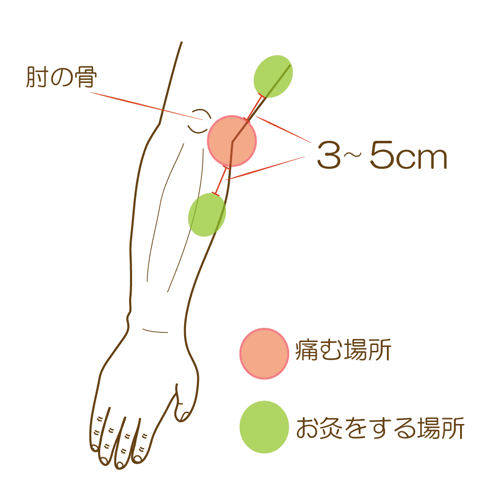 親指側の痛み
