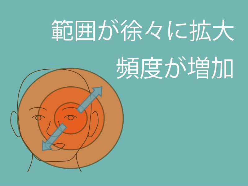 顔面痙攣